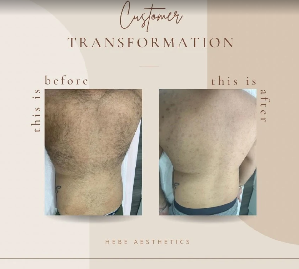 Laser Hair Removal Before and After