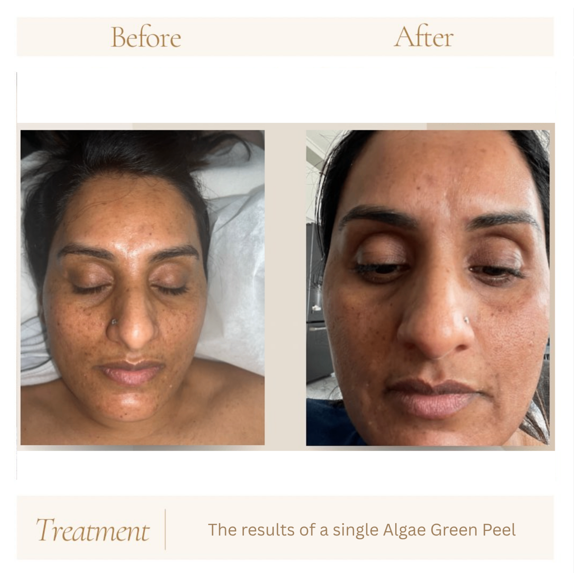 Before and after treatment results at Hebe Aesthetics Med Spa Woodbridge