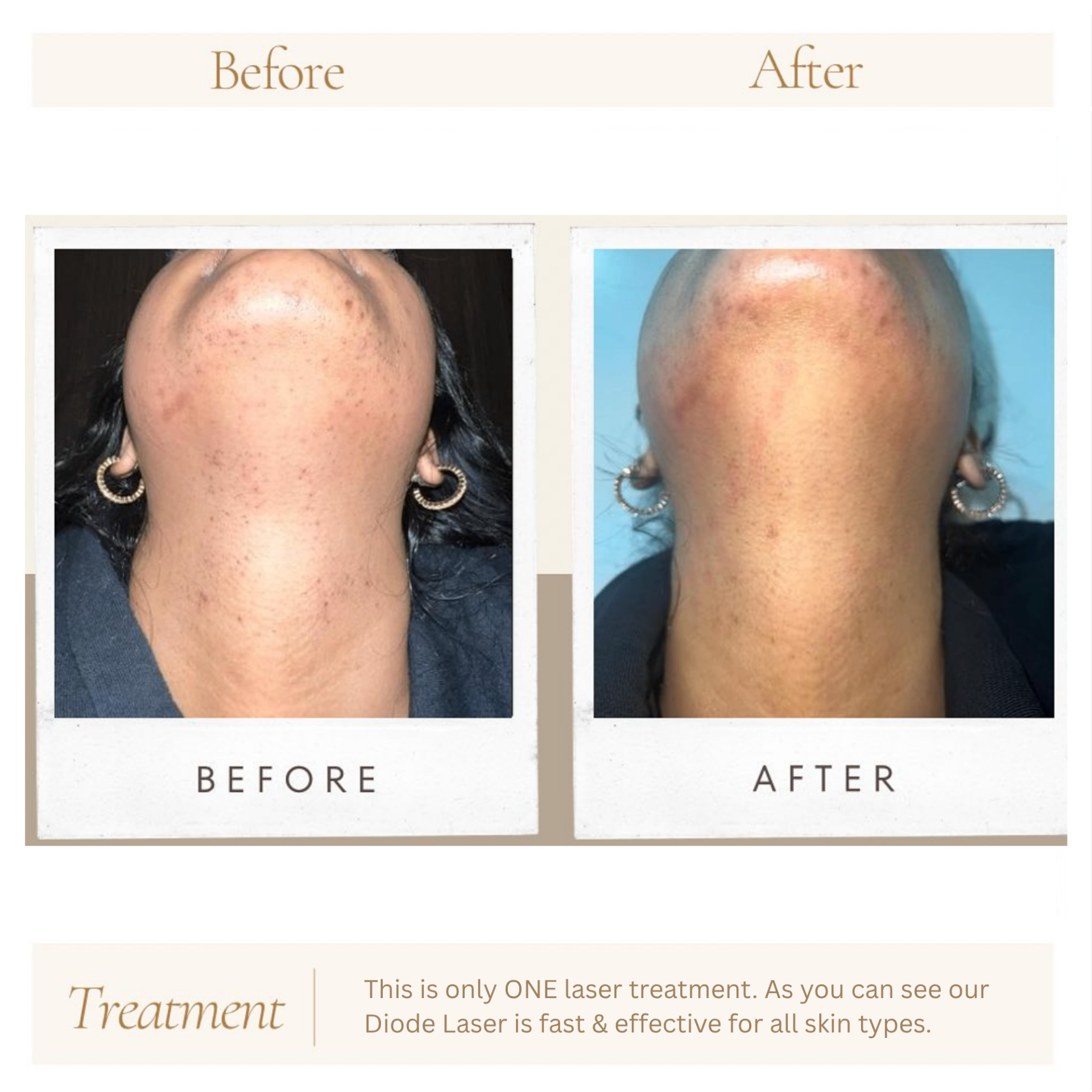 Before and after treatment results at Hebe Aesthetics Med Spa Woodbridge