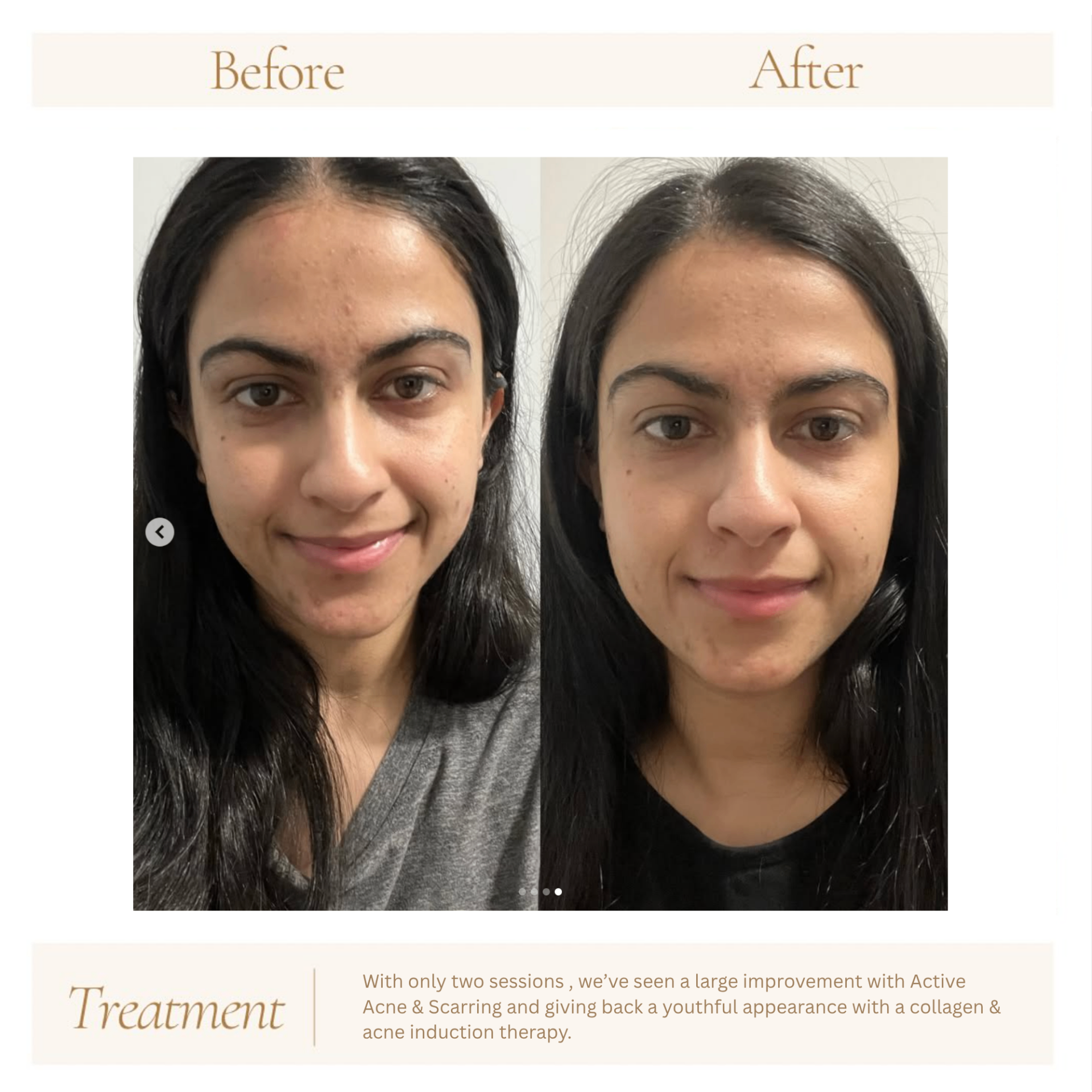 Before and after treatment results at Hebe Aesthetics Med Spa Woodbridge